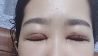Khung xương mắt lệch