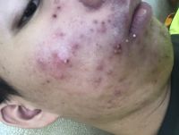 Xin hỏi uống iso lần 2 trong bao lâu ạ