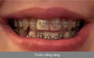 Hình ảnh niềng răng - Bác sĩ Phạm Sơn - Ca 02