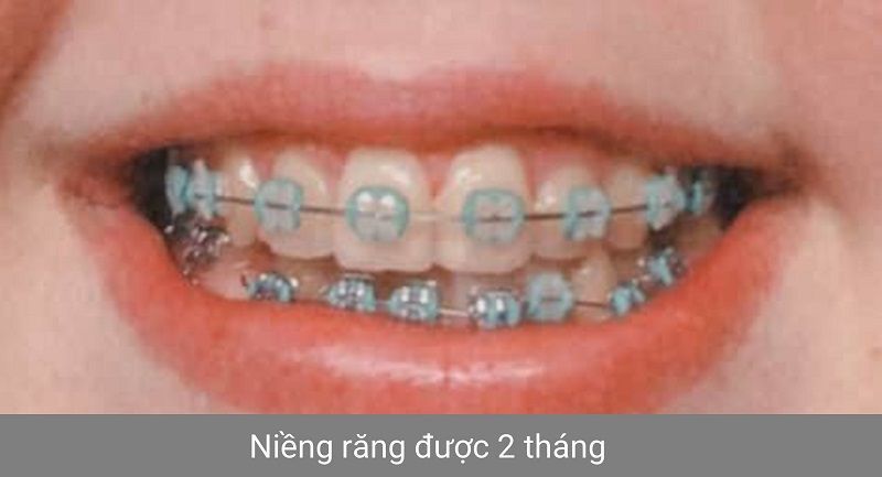 Hình ảnh niềng răng - Bác sĩ Phạm Sơn - Ca 02