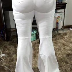 2 năm sau BBL: mông bên to bên nhỏ