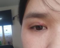 Cắt mí mắt