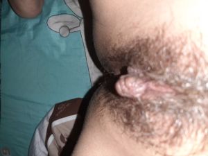 Cục thịt ở môi lớn