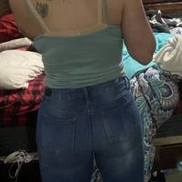 2 năm sau BBL: mông bên to bên nhỏ