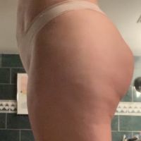 Có thể chỉnh sửa mông bất đối xứng sau BBL không?