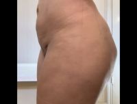 Có thể chỉnh sửa mông bất đối xứng sau BBL không?