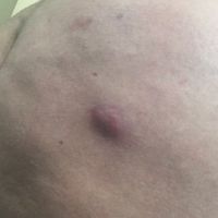 Sau BBL 6 tuần: đây là hoại tử mỡ hay nhiễm trùng?