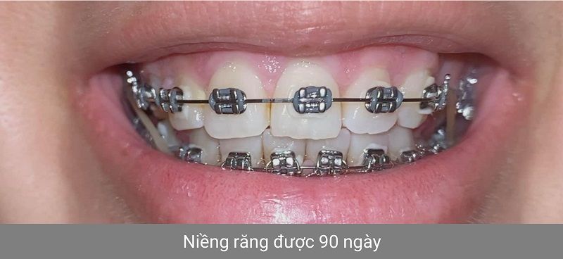 Hình ảnh niềng răng - Bác sĩ Phạm Sơn - Ca 03