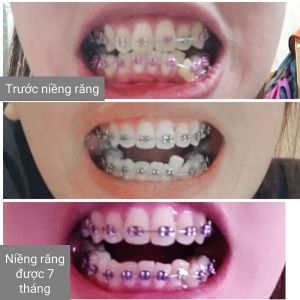 Hình ảnh niềng răng - Bác sĩ Phạm  Sơn - Ca 04