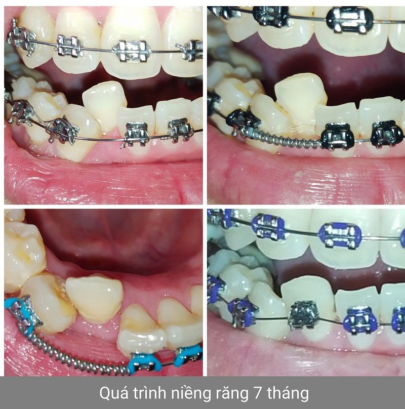 Hình ảnh Niềng răng Hình ảnh niềng răng mắc cài của KH Anh Phong  Ca 24   Bs nha khoa Lạc Việt Intech