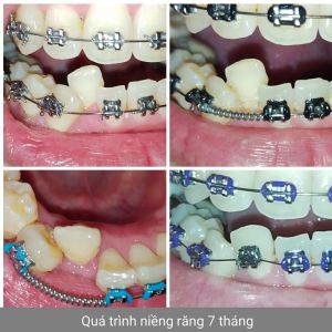 Hình ảnh niềng răng - Bác sĩ Phạm  Sơn - Ca 04