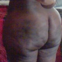 Mỡ bị hoại tử và vón cục sau nâng mông bằng mỡ tự thân