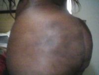 Mỡ bị hoại tử và vón cục sau nâng mông bằng mỡ tự thân