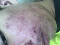 Xin hỏi uống iso lần 2 trong bao lâu ạ