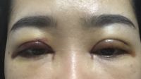 Khung xương mắt lệch