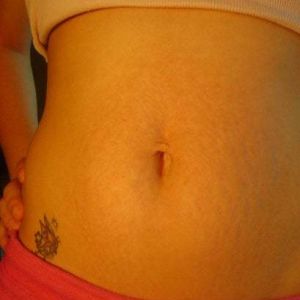 Nên chọn tạo hình thành bụng toàn phần hay tạo hình thành bụng mini: sợ sẹo dài và rạn da.