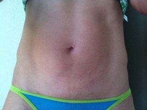 Tạo hình thành bụng mini có giúp tôi lấy lại múi bụng?