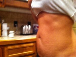 Tôi nên làm tạo hình thành bụng mini hay tạo hình thành bụng toàn phần?