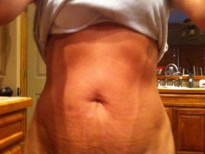 Tôi nên làm tạo hình thành bụng mini hay tạo hình thành bụng toàn phần?