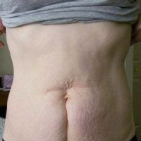 Có thể làm tạo hình thành bụng mini để trị sẹo dọc do mổ lấy thai không?