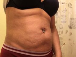 Tôi có nên làm tạo hình thành bụng mini không?