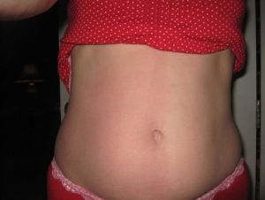 Nên làm hút mỡ hay tạo hình thành bụng mini để có kết quả tốt  nhất?