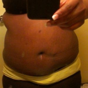 Đây chỉ là sưng nề? Bụng tôi có phẳng ra được không?