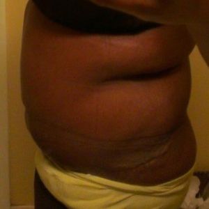 Đây chỉ là sưng nề? Bụng tôi có phẳng ra được không?