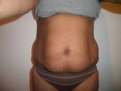 Tôi nên chọn tạo hình thành bụng hay hút mỡ?