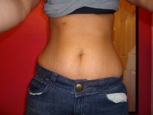 Tôi 23 tuổi, có một con. Tôi nên chọn tạo hình thành bụng mini hay toàn phần?