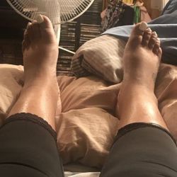 Sưng cổ chân và bàn chân 5 ngày sau tạo hình thành bụng thì có bình thường không?
