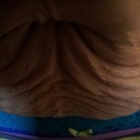 Cơ bụng không hề bị phân tách, nhưng da siêu chảy xệ?