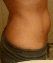 Đã sinh con thì nên hút mỡ, làm tạo hình thành bụng toàn phần hay tạo hình thành bụng mini?