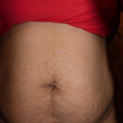 Tôi có cần làm tạo hình thành bụng mini không hay chỉ hút mỡ là đủ?