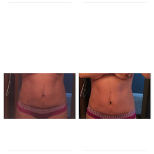 9 Tuần sau tạo hình thành bụng mini và hút mỡ bụng/hai bên sườn, tôi vẫn bị sưng nề hay là lại tăng cân?