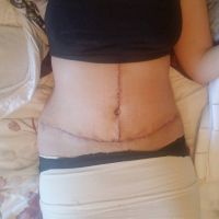 Thay băng ép do bệnh viện phát bằng đai nịt bụng có được không?