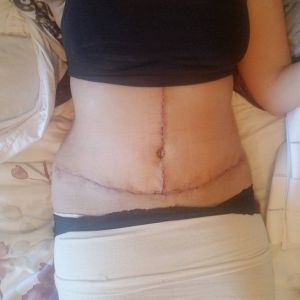 Thay băng ép do bệnh viện phát bằng đai nịt bụng có được không?