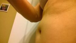 Tôi làm tạo hình thành bụng năm 2010. Đến 2011 vẫn không hết sưng nề và phù nề. Phía trên rốn bị lồi.