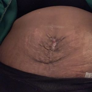 Tôi đã làm tạo hình thành bụng 4 tuần trước. Tôi có nên lo lắng không? Có nên đi xin ý kiến từ bác sĩ khác không?