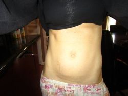 Có thể chữa rốn khi làm tạo hình thành bụng mini không?