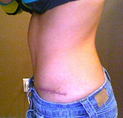 4 tháng sau phẫu thuật tạo hình thành bụng toàn phần mà bụng trên vẫn sưng như cũ