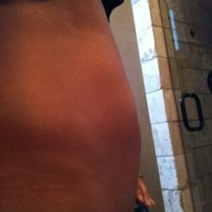 Thủ thuật nào sẽ là tốt nhất cho tình trạng bụng của tôi?