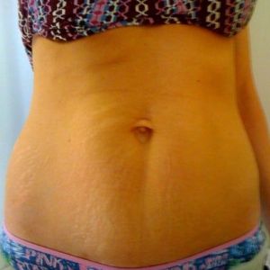 Cơ thể săn chắc thì có thể làm tạo hình thành bụng mini không?