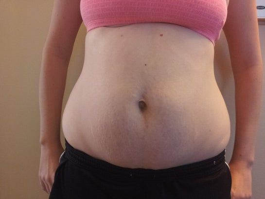 Cao 1m7, 26 tuổi, có 2 con, định phẫu thuật nâng ngực. Tôi có nên làm thêm tạo hình thành bụng toàn phần hay tạo hình thành bụng mini kèm hút mỡ hai bên không?