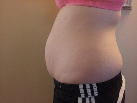 Cao 1m7, 26 tuổi, có 2 con, định phẫu thuật nâng ngực. Tôi có nên làm thêm tạo hình thành bụng toàn phần hay tạo hình thành bụng mini kèm hút mỡ hai bên không?