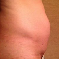 Tạo hình thành bụng và hút mỡ có chữa được bụng lồi bên trên sẹo mổ không?
