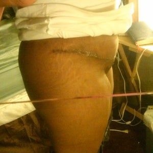 Tôi có thể dùng miếng chườm nóng nhiệt độ thấp để dịch chuyển phù nề ở bụng dưới và khu vực mu không?