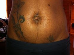 Tôi có phù hợp làm tạo hình thành bụng mini và cấy mỡ tự thân ở mông không?