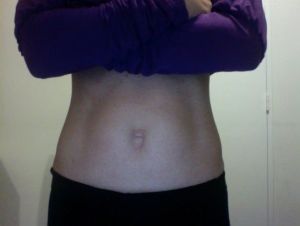 Tạo hình thành bụng mini hay tạo hình thành bụng toàn phần – thủ thuật nào phù hợp với tôi nhất?