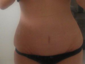 Nếu rốn của tôi bị nhấc lên trong quá trình làm phẫu thuật, thì tôi có nên làm một vết rạch quanh rốn không?